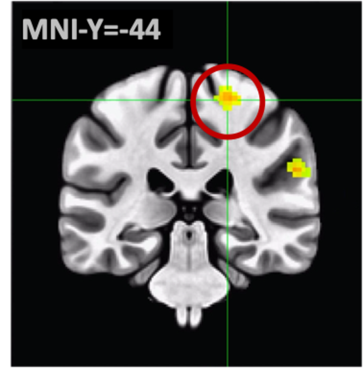 x-ray image of brain with activity highlighted