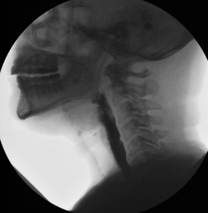 x-ray video shot of swallowing